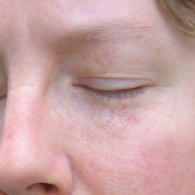 Raised Red Patch Under Eye